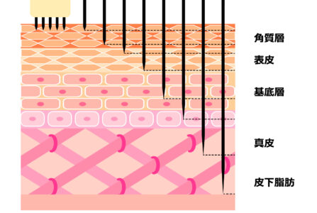 ダーマペンとはどのような施術か